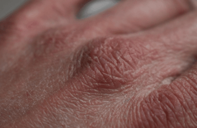 Piele sensibilă: Cauze și tratament