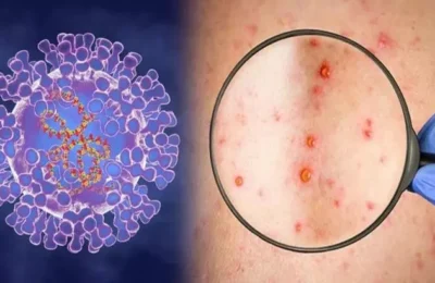 Trei noi cazuri de variola maimuței au fost diagnosticate în România