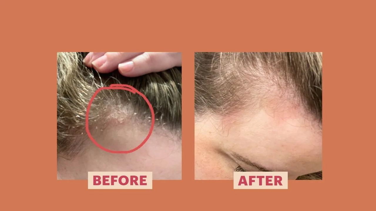 Psoriazisul meu de scalp a apărut de nicăieri – Iată cum l-am tratat