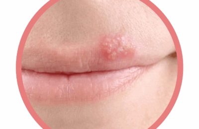 Răceală vs coș: Cum să preveniți, să tratați și să faceți diferența între ele