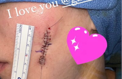 Khloé Kardashian a dezvăluit crestătura lăsată pe fața ei în urma îndepărtării cancerului de piele – Vezi poze