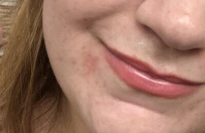 Dermatita mea periorală arăta ca o piele uscată în jurul gurii mele