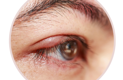 6 tipuri de umflături pe pleoape și cum să le tratezi, potrivit dermatologilor