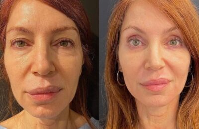 Blefaroplastie: Procedura de ridicare a pleoapelor este în creștere – dar este sigură?