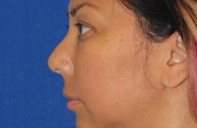 13 oameni sunt realiști în legătură cu operațiile lor de lifting facial – cu înainte și după