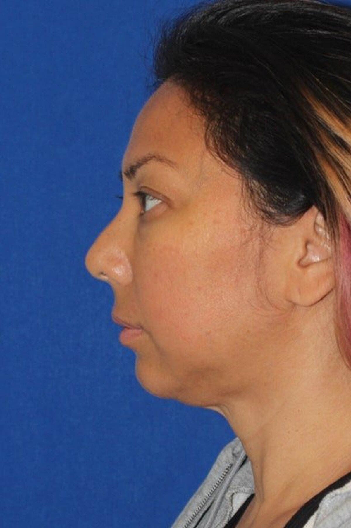 13 oameni sunt realiști în legătură cu operațiile lor de lifting facial – cu înainte și după