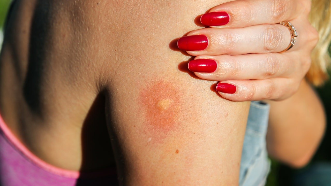 Cum să scapi rapid de mușcăturile de insecte (pentru că scărpinatul nu este răspunsul)