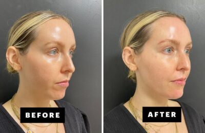 Mi-am făcut pentru prima dată umplutură pentru bărbie – vezi fotografiile înainte și după