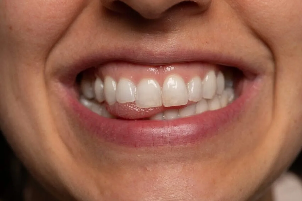 Îngrijirea ulterioară pentru tratamentele dentare: Sfaturi de la experții Dentakay
