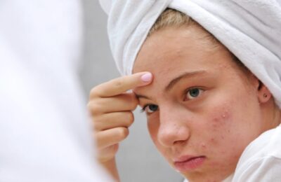 Top 5 sfaturi pentru îngrijirea tenului cu tendință acneică