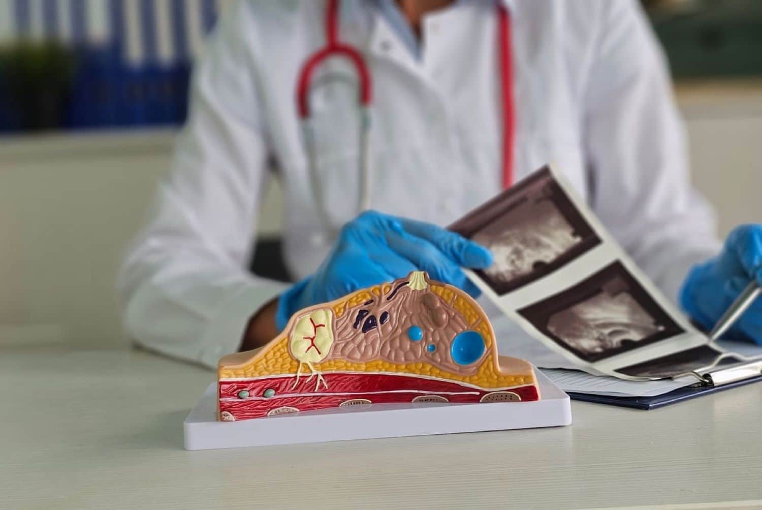 RMN vs. Mamografie: Care e mai bun?