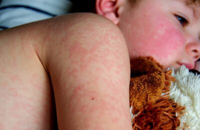 Revenirea puternică a epidemiei de rujeolă în Europa: Record de cazuri în România
