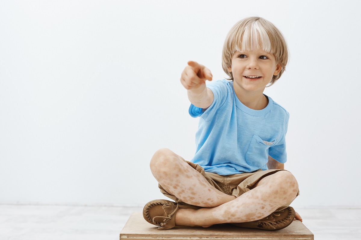 Tratament eficient pentru vitiligo la toate vârstele: terapia cu imunoglobulina Y de tip aviar.