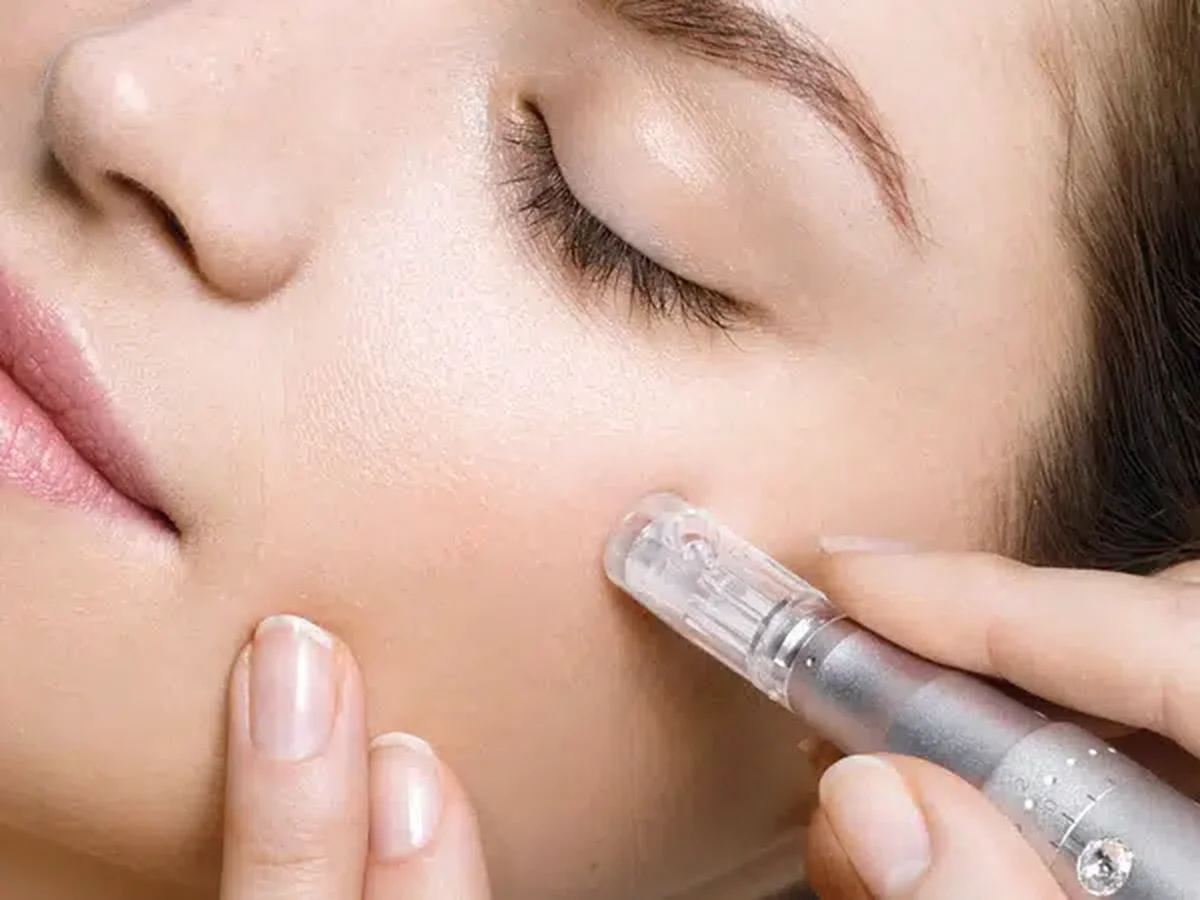 Microneedling: Risc sau beneficiu pentru femei?