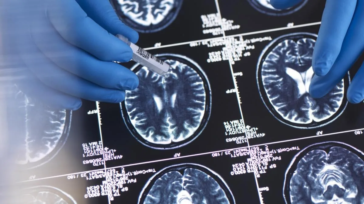 poluare Alzheimer, studiu poluare