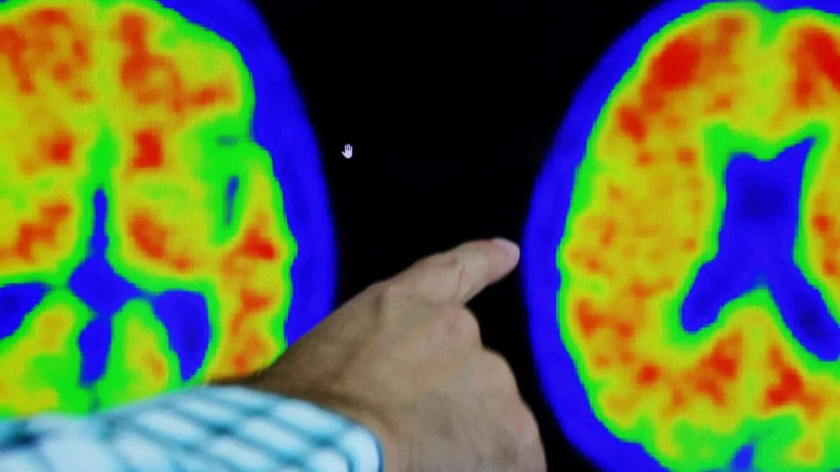 test sange alzheimer