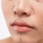 Colegiul Medicilor a demarat o anchetă, după moartea femeii de 45 de ani, în cadrul uni lifting facial