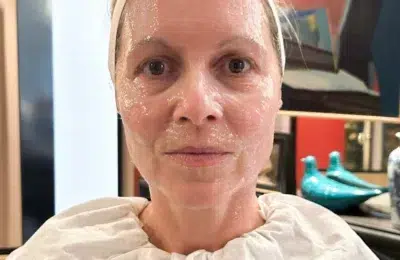 Liftingul facial de 4.000 de lire care promite rezultate fără bisturiu