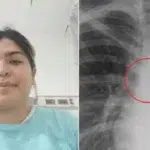 O tânără de 26 de ani a descoperit un piercing în plămâni la 0,5 mm de aortă