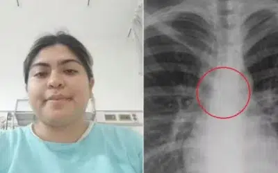 O tânără de 26 de ani a descoperit un piercing în plămâni la 0,5 mm de aortă