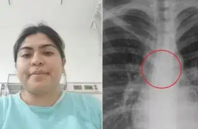 O tânără de 26 de ani a descoperit un piercing în plămâni la 0,5 mm de aortă