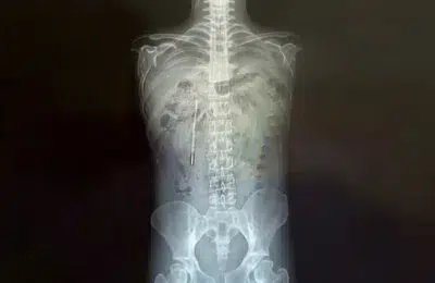 Medicii au scos un termometru din stomacul unui bărbat după 20 de ani