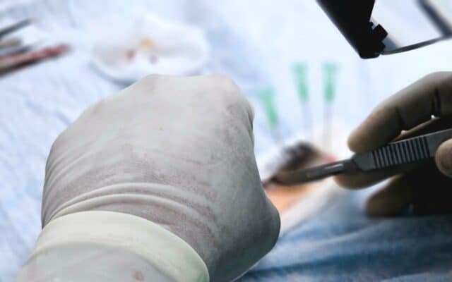 Intervenție chirurgicală de transplant cardiac
